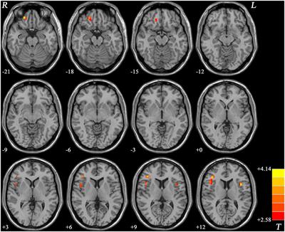 Enhanced Prefrontal Regional Homogeneity and Its Correlations With Cognitive Dysfunction/Psychopathology in Patients With First-Diagnosed and Drug-Naive Schizophrenia